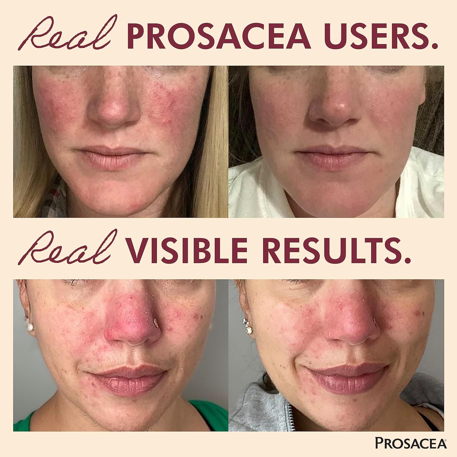 Prosacea Controls Maskne Rosacea Symptoms of Redness, Pimples & Irritation, 0.75 Oz-1