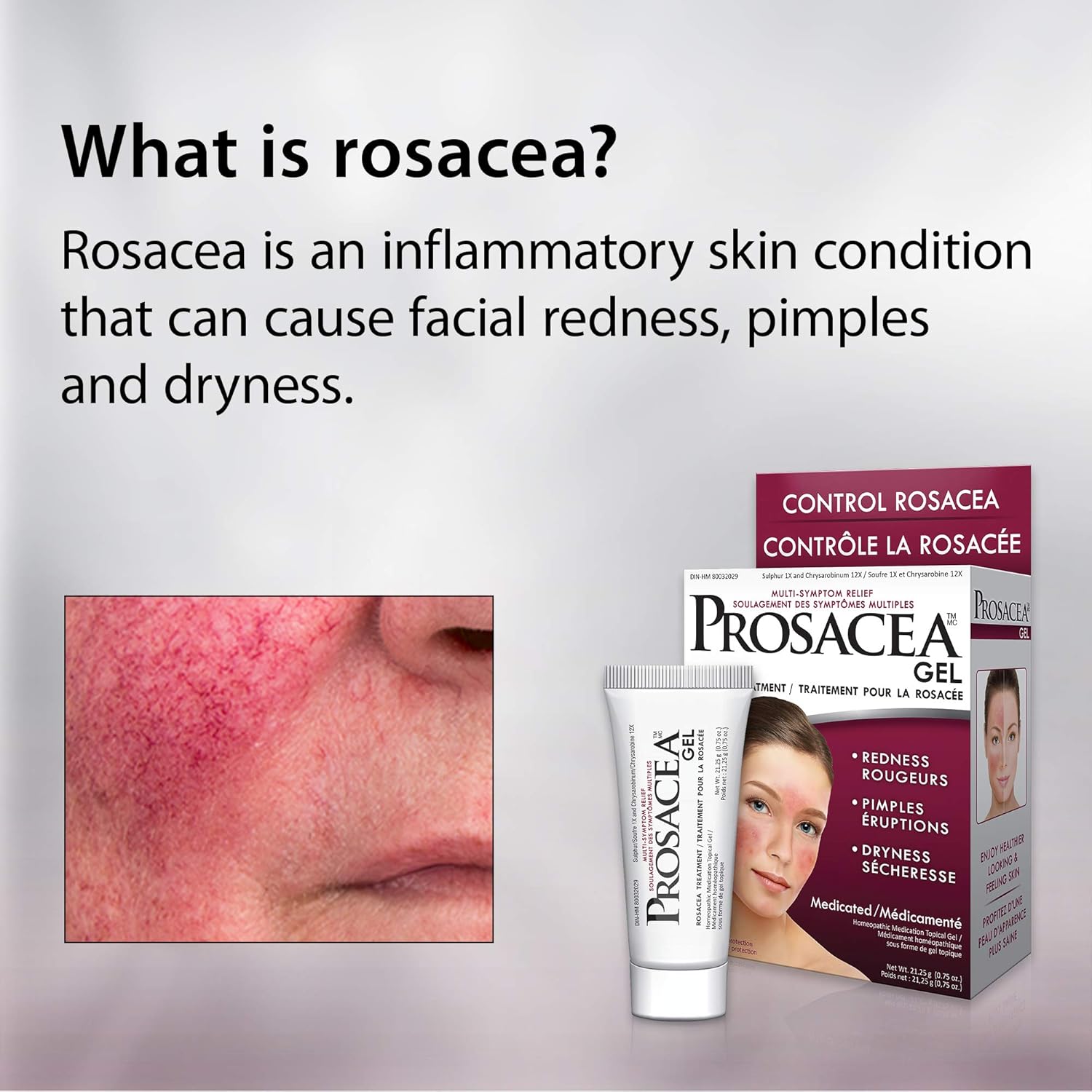 Prosacea Rosacea Treatment Gel, 0.75 Ounce-3