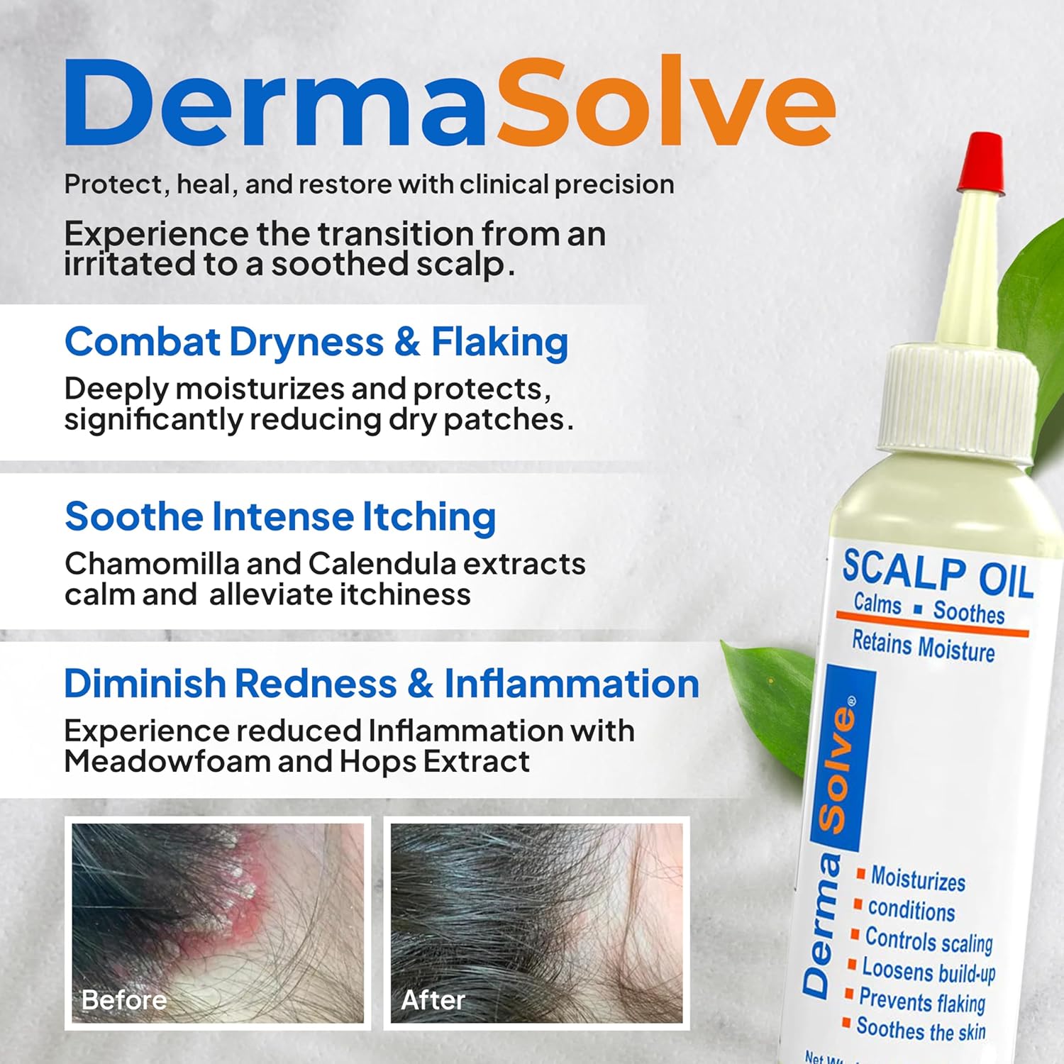 Dermasolve Psoriasis & Dandruff Scalp Oil, Dermatologist Approved for Flaky Scalp Relief-1