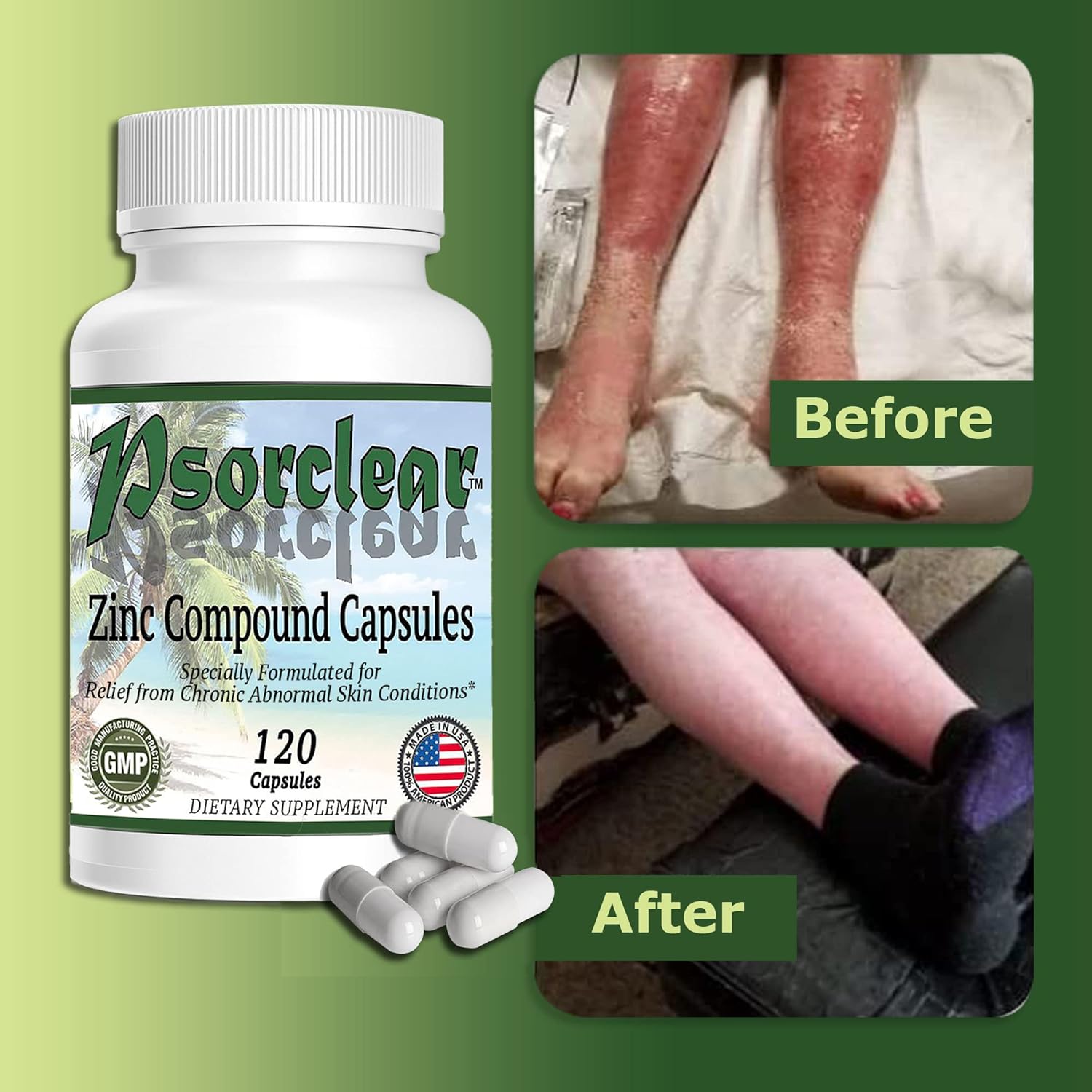 Psorclear-Psoriasis & Eczema Relief | A Proven Effective and All-Natural Product for Psoriasis Eczema & Rosacea Relief That Works - Rated One of The Best (120 Count Bottle)-3