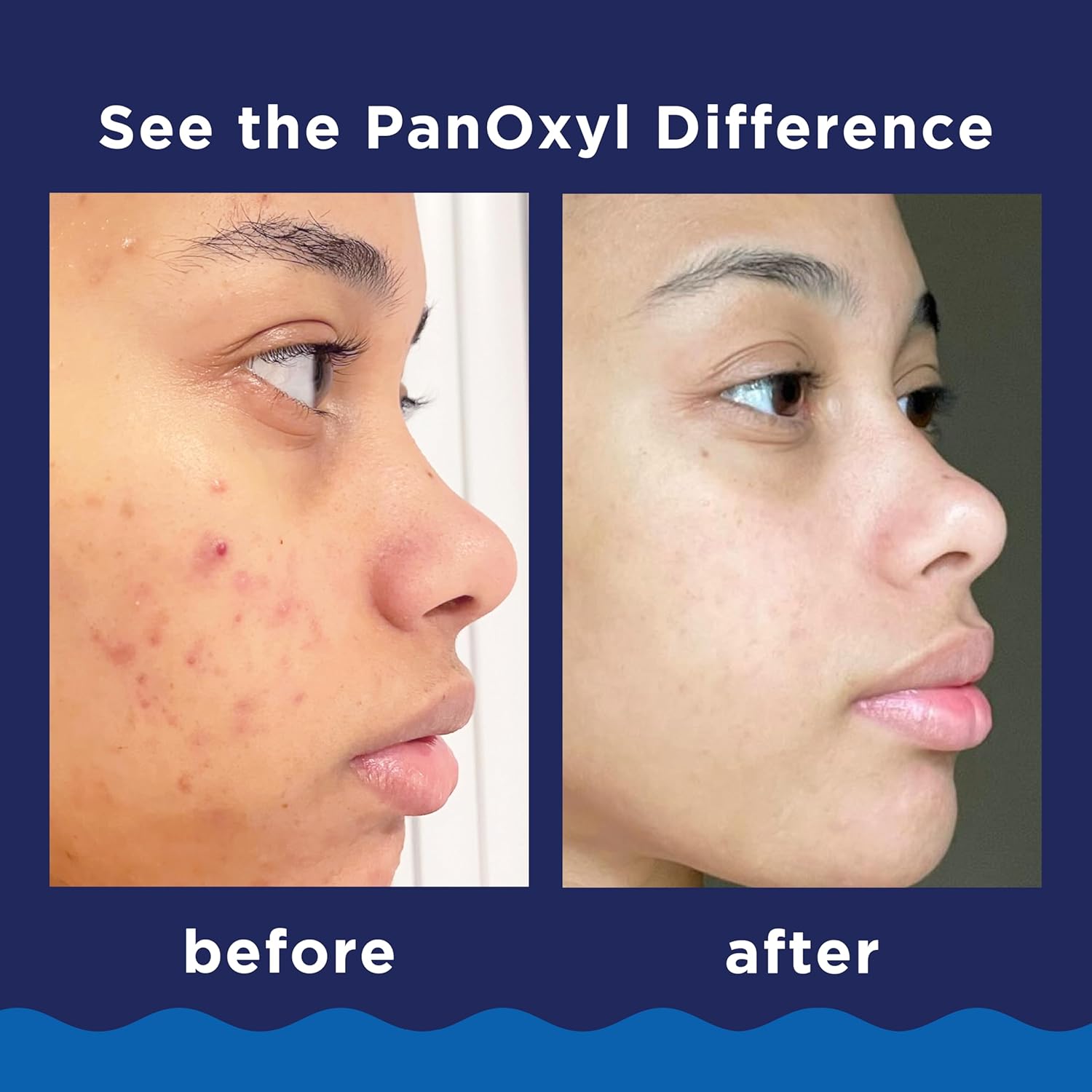 PanOxyl Acne Foaming Wash Benzoyl Peroxide 10% Maximum Strength Antimicrobial, 5.5 Oz-4