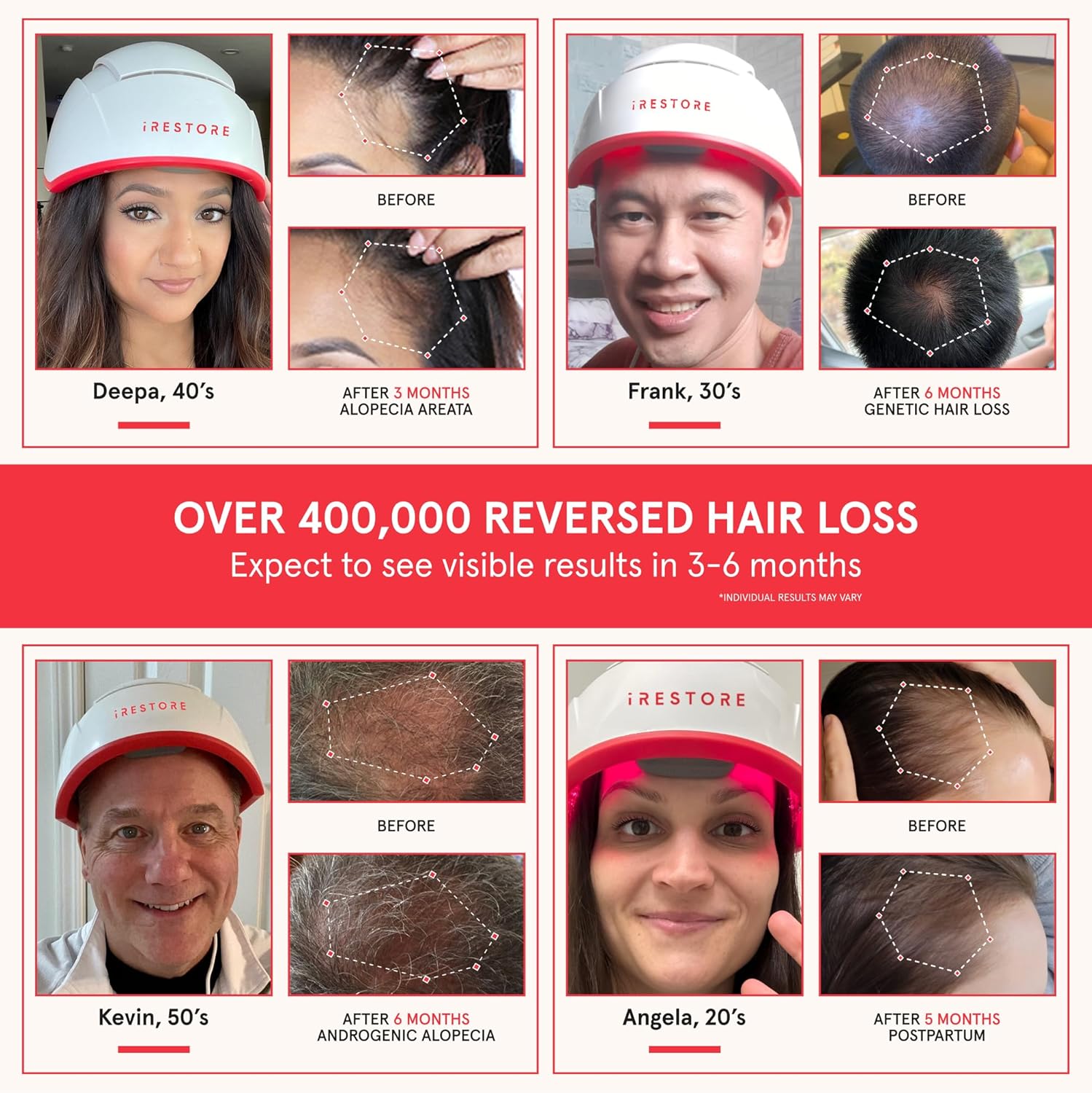 iRestore Professional Laser Hair System - FDA Cleared Hair Growth Cap for Men and Women with Thinning Hair or Hair Loss-1