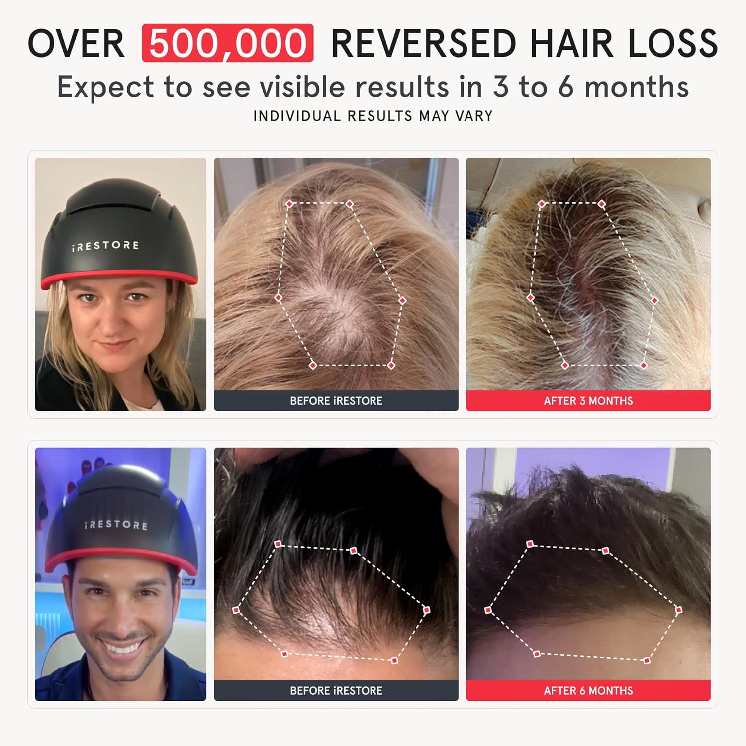 iRestore Elite - Laser Red Light Therapy for Hair Growth System - FDA Cleared Hair Loss, Hair Thinning & Alopecia Treatment for Men & Women - Laser Cap for Hair Regrowth Stimulates Denser Fuller Hair-1