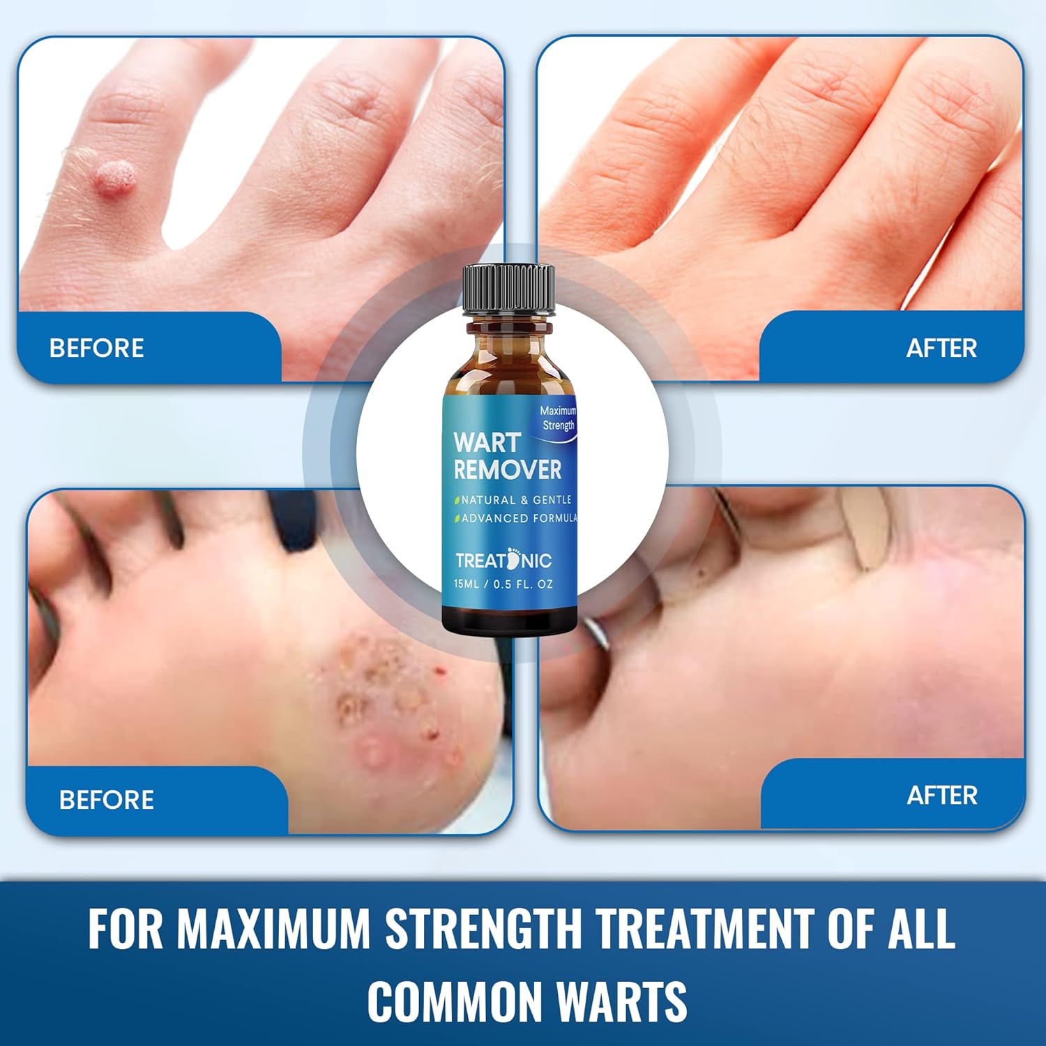 Maximum Strength Wart Remover: Fast-Acting Wart Removal, Painlessly Removers Plantar, Common, Flat Wart Treatment Freeze Off-3